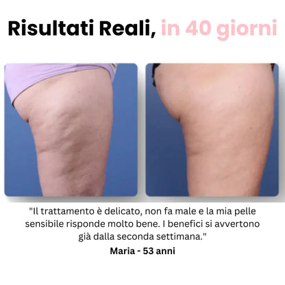 Velora™ - Anti Cellulite Massaggiatore
